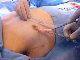 Gynecomastia konzervatív és sebészi kezelés