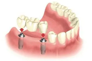 În cazul în care mai bine de a face preturi implant dentar, poze