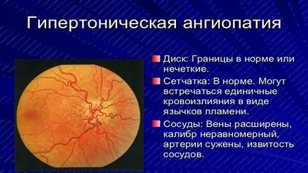 Hipertensivă retinopatiei - ceea ce este