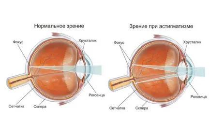 Hyperopic астигматизъм, симптоми, диагностика и лечение