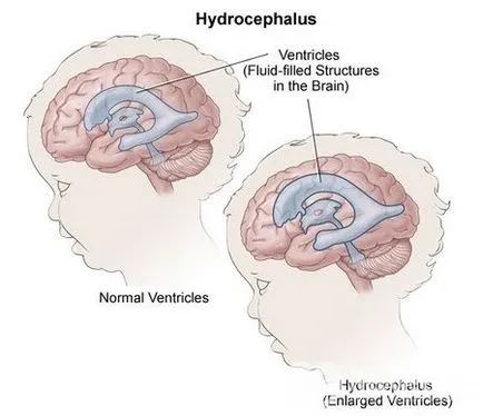 мозъка хидроцефалия при деца и възрастни, лечението