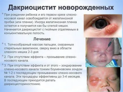 Гнойни очите на едно новородено бебе у дома, отколкото лечение и grudnichka, капки, сълзи, отколкото да се изтрие