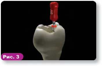 Guttacore - viitorul obturatie de canal - Clinica Centrala dentara