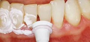 Имплантирането на зъбния емайл (възстановяване)