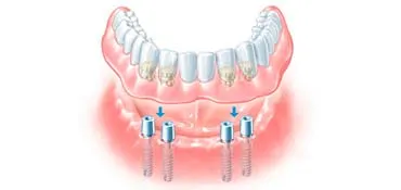 A fogászati ​​implantátumok Izhevsk árak, implantátumos fogpótlás