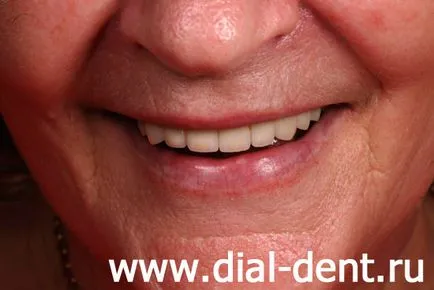 Implanturile dentare pentru diabet