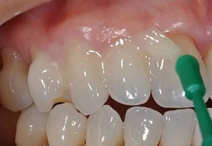 Имплантирането на зъбния емайл технология, цена, ревюта