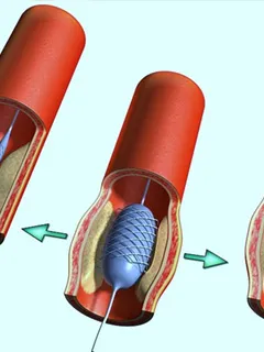 Minőségi artéria ballon angioplasztika - a számos probléma megoldását! A viselkedését a ballon
