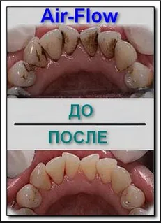 Колко често мога отстраняване на зъбен камък