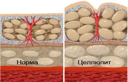 Как да се отървете от целулита бързо и у дома