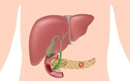 Cum de a trata hepatomegalie ficat