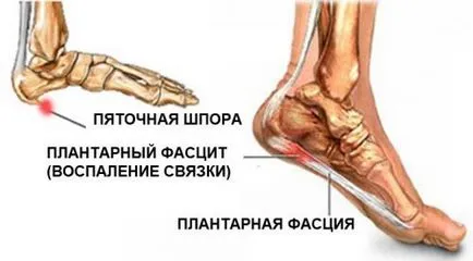 Шипове в петата, както и от за лечение - Въпроси за жени