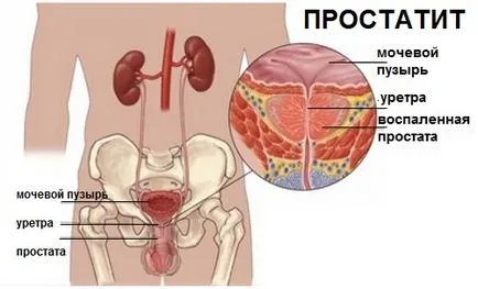 Какви са последиците от простатит за здравето на мъжете