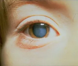Tünetei és kezelése a szem homályok