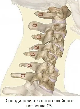 Simptomele, tratamentul dislocare cervicală