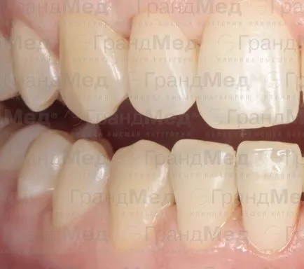 Как да се грижим за зъбите си след премахване на скобите
