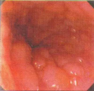 Hogyan lehet gyógyítani a Crohn-betegség