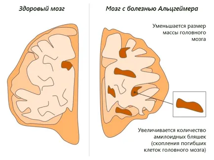 Да живееш с болни от Алцхаймер - съвети за семейства