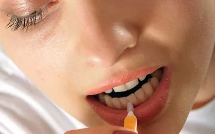 Üregek között, a fogak kezelésére, interproximalis fogszuvasodás (fotó és videó)