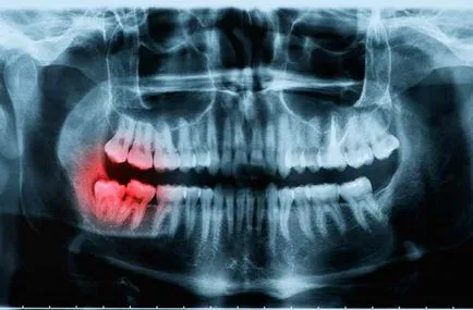 Üregek között, a fogak kezelésére, interproximalis fogszuvasodás (fotó és videó)