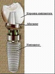 Clasificarea implanturilor