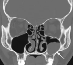 A cisztás sinusitis - Kezelés és tünetek