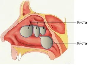 Cisztás sinusitis okoz, tünetek és a kezelés a betegség