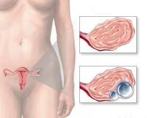 Chist ovarian și cystoma