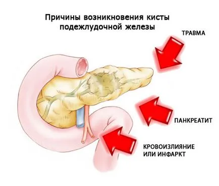 Pancreatică Chist cauze, simptome și tratament