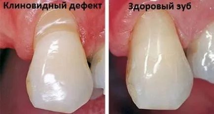 Ék alakú hibák fogak - kezelés otthon, a kezelés költsége