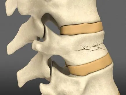 Компресия фрактура на гръдни симптомите на гръбначния стълб и лечение
