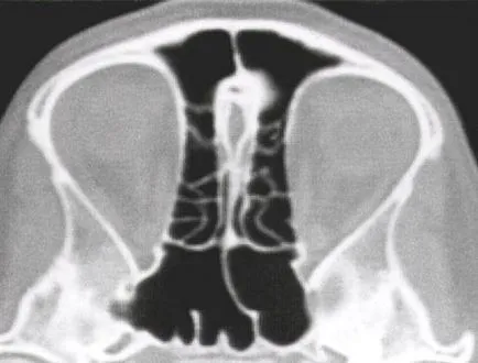Компютърна томографско анатомия на УНГ органи, страница 6