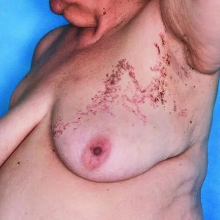 Lichen planus (foto) - cauze, diagnostic și tratament