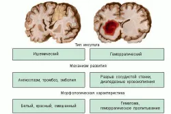 Az agyi ischaemia kezelésénél gyógyszerek, súlyosságától, a tünetek, etiológiai tényezők