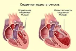 Tratamentul de dispnee de remedii populare insuficienta cardiaca