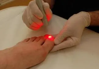 Îndepărtarea cu laser de unghii incarnate