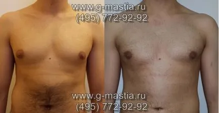 Gynecomastia kezelésére férfiaknál művelettípusokat