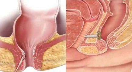 Tratamentul Apendicita de remedii populare