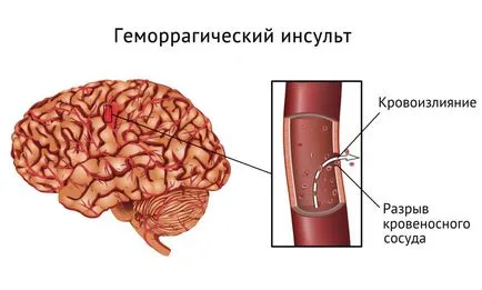 tratament accident vascular cerebral si pacienti de reabilitare ulterioare