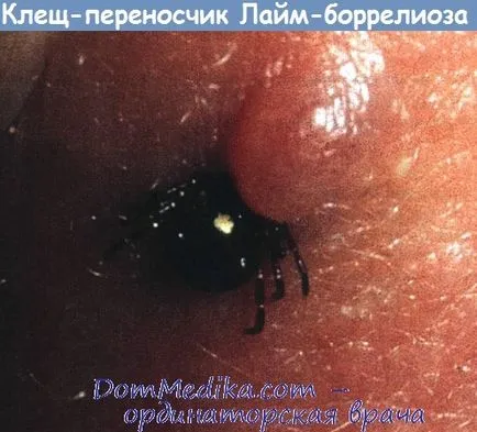 Borelioza Lyme - diagnostic, tratament