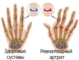 A rheumatoid arthritis kezelése népi jogorvoslati és táplálkozási