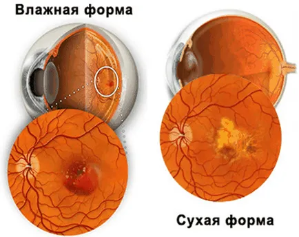 makula degeneráció a retina okoz a szem, a kezelés és a megelőzés