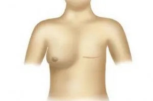 Mastectomie (intervenție chirurgicală pentru a elimina de san)