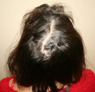 Minoxidil este un medicament pentru pierderea parului la femei