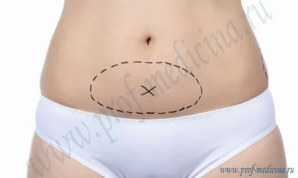 fotografii Miniabdominoplastika înainte și după, ceea ce este, indicații, tipuri