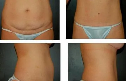 fotografii Miniabdominoplastika înainte și după comentarii