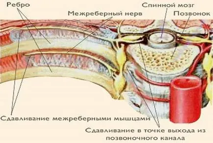 Intercostal nevralgiei - cauze, simptome și tratament