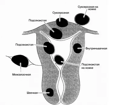 miomul uterin (fibrom), simptome, cauze, diagnostic si tratament