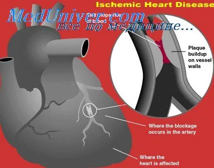 Morfologia de infarct miocardic - tratament de inima