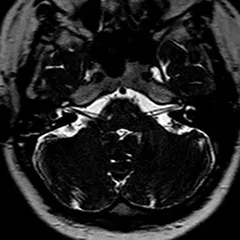 MRI a belső fül, a belső fül képalkotó Moszkva